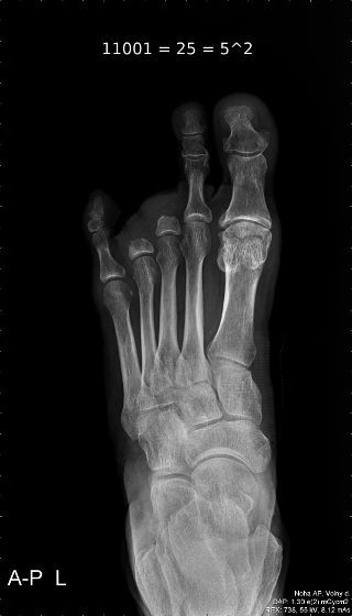 Digiti 25 (Three toes - amputated toes X-ray, 11001=25=5^2)