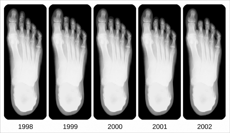 RTG (Four toes - amputated toe X-rays)